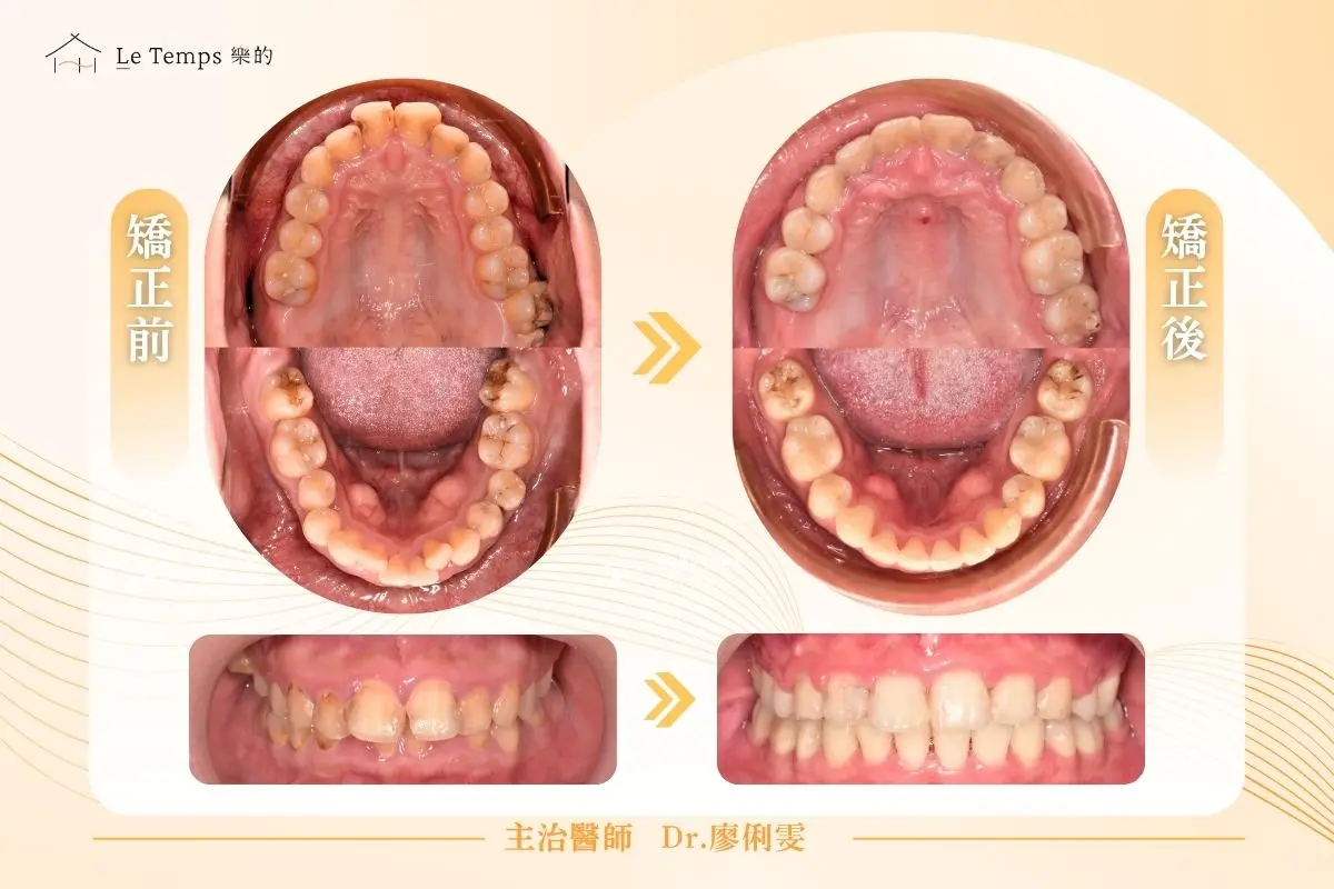 自鎖式矯正前後對比 1