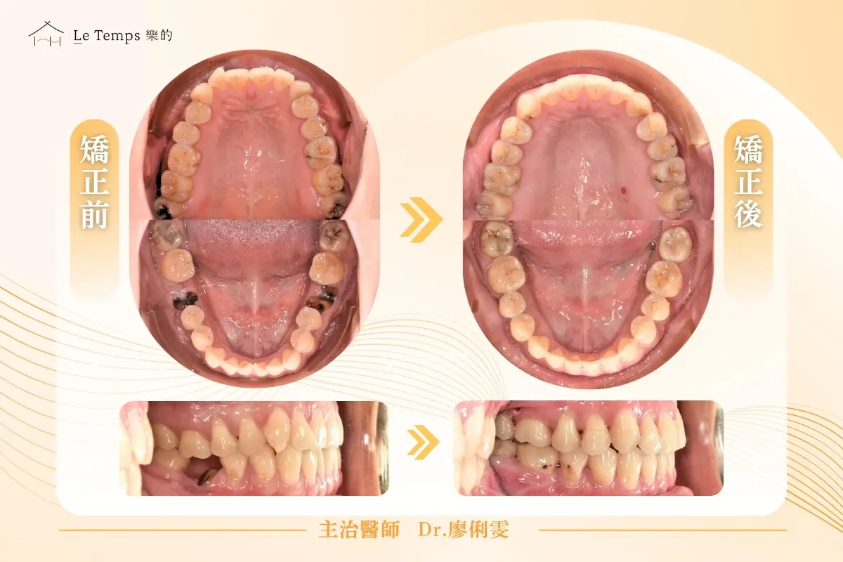 自鎖式矯正前後對比 2