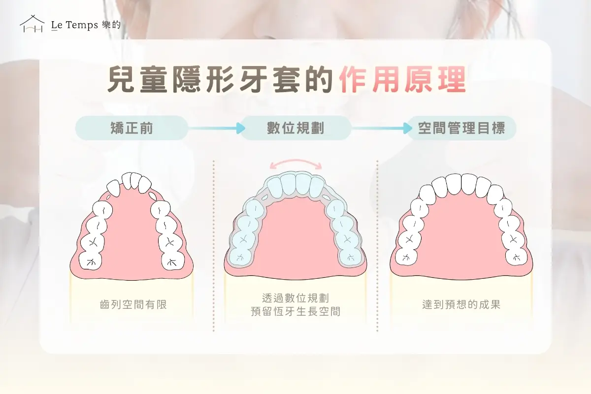 兒童隱形牙套的作用原理